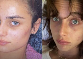 8 slavnih koji se bore s aknama: od Camilie Cabello i Lucy Hale do Petea Davidsona i Emme Chamberlain – tko je glumac izgubio ulogu u OC-u zbog svog stanja kože?