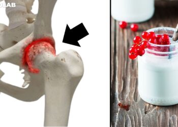 Prirodni lijekovi koji vraćaju hrskavicu kuka