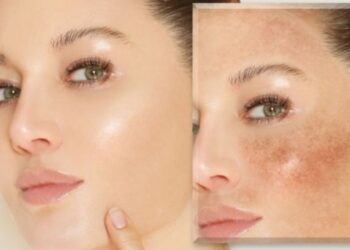 Čine li tamne mrlje da izgledate starije? Evo kako se boriti protiv hiperpigmentacije | Zdravlje