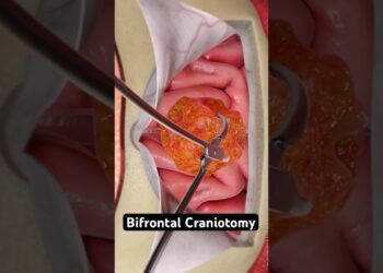 Uklanjanje tumora iz vašeg mozga (3D animacija)