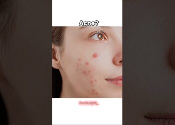 Riješite se akni, mitesera kod kuće 🌷✨ | #SkinCare #shorts #astetic #fyp #kpop