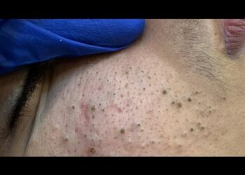 * Nesporodana* Rutina liječenja od akni: Moji vrhunski lijekovi za čistu kožu