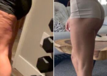 Vlasnik teretane koji je drastično smanjio celulit pripisuje trening tri puta tjedno transformaciji bedara.