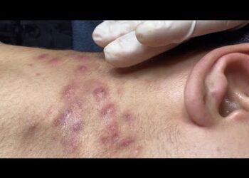 Liječenje tinejdžerskih akni P.2 #hoangmyspa170