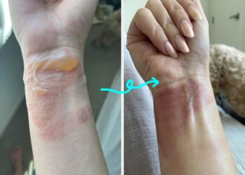 16 proizvoda za njegu tijela s kvrgavim fotografijama prije i poslije