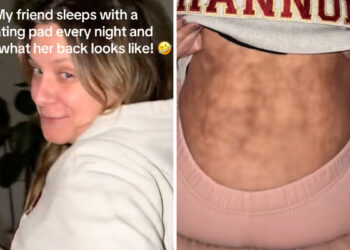 Žena koja noću koristi jastučić za grijanje otkriva “sindrom pečene kože”